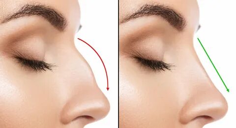 Rhinoplasty