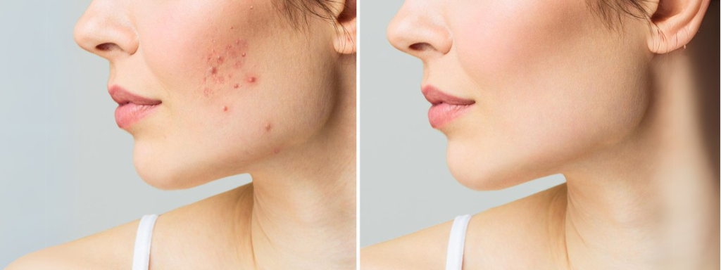 scar treatment in mumbai